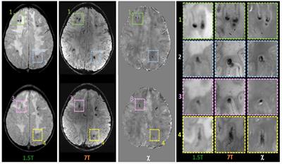 Case report: Exploring chemoradiotherapy-induced leukoencephalopathy with 7T imaging and quantitative susceptibility mapping